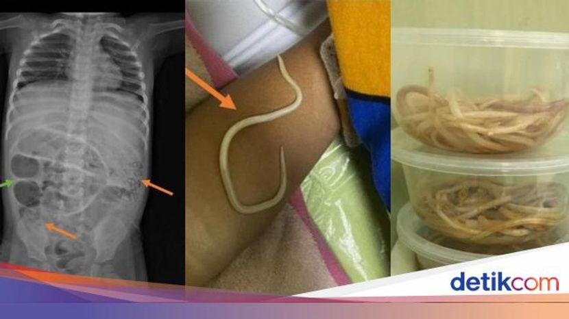 蛔虫侵蚀印尼三岁幼童全身再爬出体外