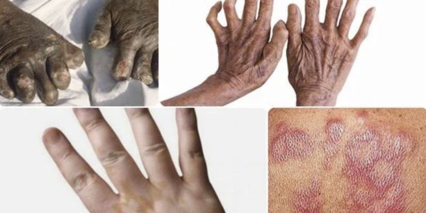 罗马尼亚报告40余年首例麻风病，患者为印尼公民